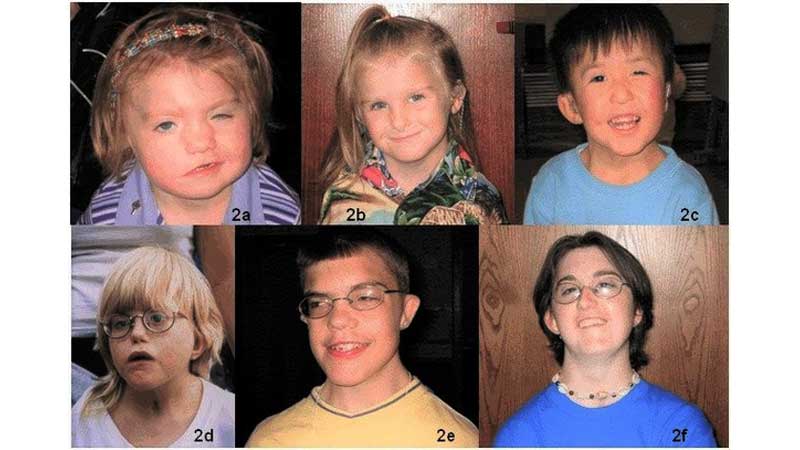 NewCa.com: A genetic disease in children under the microscope of - Vimarsana News